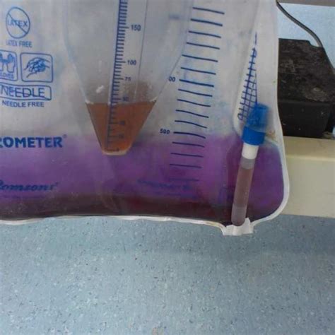 A Startling Discovery: The Phenomenon of Violet Urine