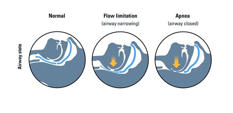 Apnea's Figure: Facts Revealed