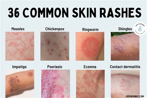 Autoimmune Disorders: How They Manifest as Facial Rashes