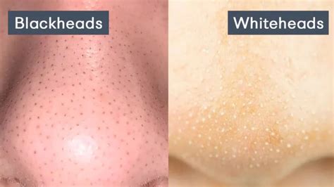 Blackheads vs. Whiteheads: Understanding the Distinctions and Significance