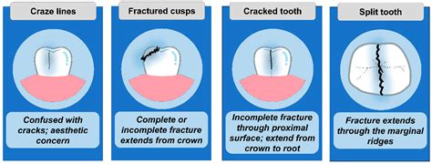 Causes and Effects of Tooth Fractures