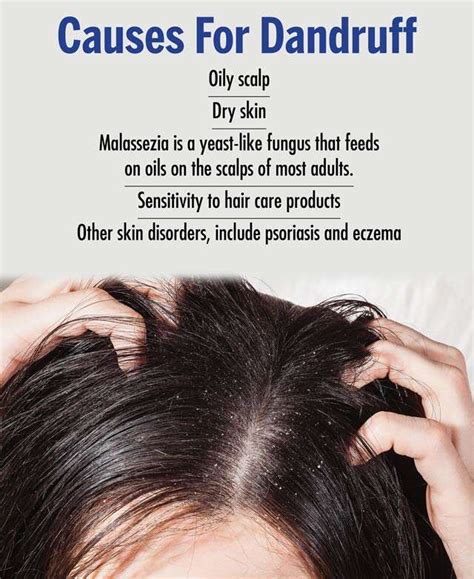 Causes of Dandruff and Common Misconceptions