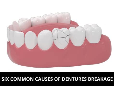 Common Causes of Denture Breakage