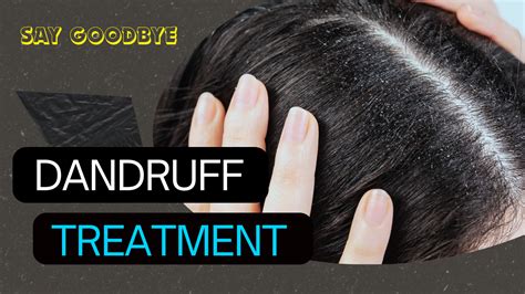 Conquering Dandruff: Effective Remedies and Treatments