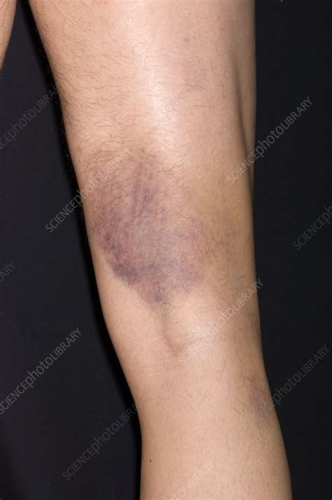 Cultural and Historical Significance of Bruised Legs