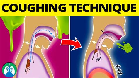 Decoding the Meaning Behind the Act of Expelling Fish Through Coughing