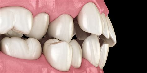 Decoding the Significance of Misaligned Front Teeth Dreams