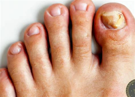 Delve into Subconscious Significance of Dreams Involving Toenails