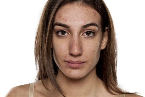 Diet and Acne: Dispelling the Misconception