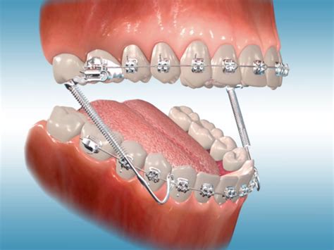 Different Types of Orthodontic Appliances for Individuals in One's Dream of Wearing Orthodontic Appliances