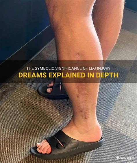 Dream Interpretation: Decoding the Symbolism of a Leg Injury