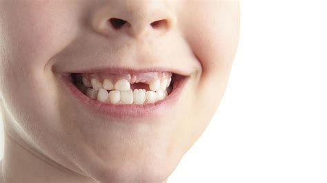 Dreams Involving Tooth Loss: A Widespread Phenomenon