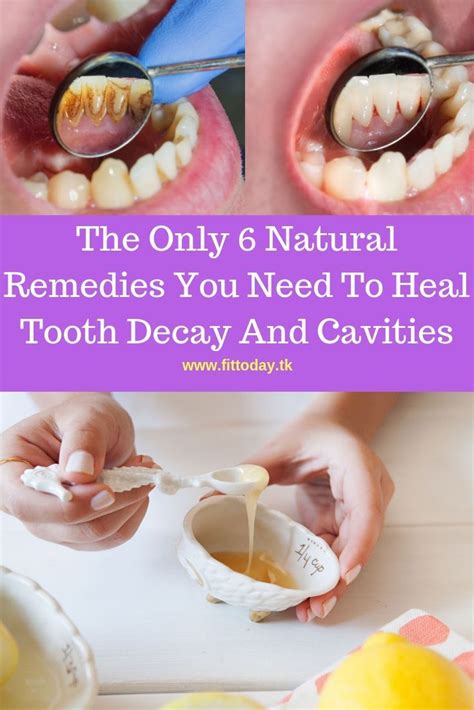 Effective Remedies to Combat Tooth Decay at Home