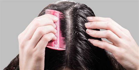 Effective Tips for Managing Severe Dandruff at Home