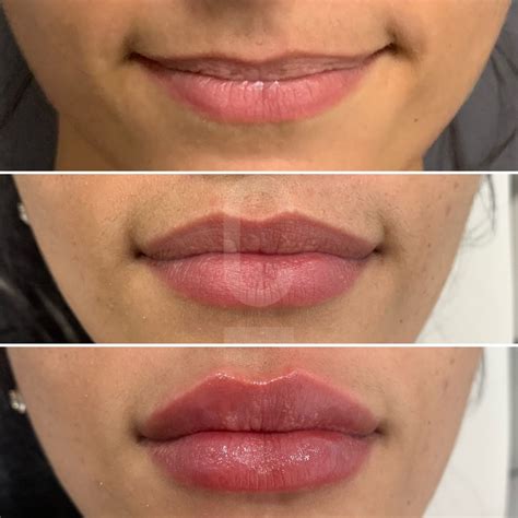 Enhancing Your Natural Beauty: Choosing the Right Lip Filler