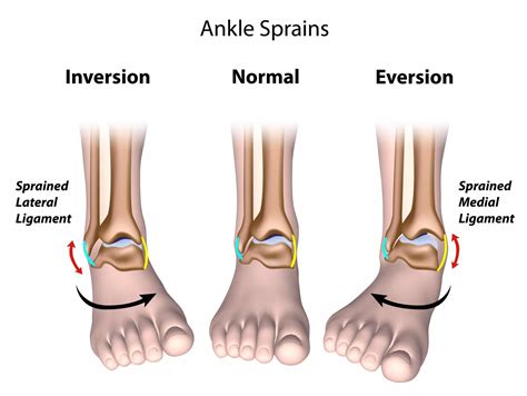 Exploring Ankle Sprains: Underlying Factors and Varieties