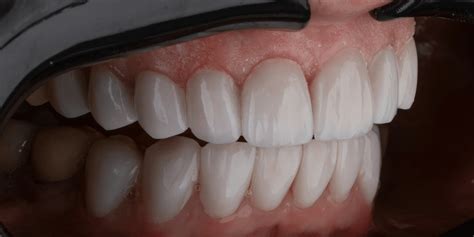 Exploring Different Approaches to Achieving Dental Alignment