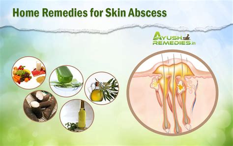 Exploring Natural Remedies and Home Treatments for Abscesses
