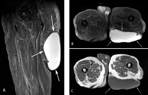 Exploring Possible Causes for Reoccurring Hemorrhagic Visions Involving the Gluteal Region