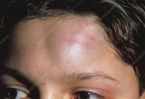 Exploring Possible Medical Explanations for Dreams Involving an Injury on the Forehead