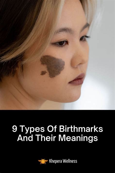 Exploring the Hidden Symbolism of Facial Birthmarks