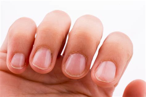 Exploring the Link Between Dreams and Physical Well-being: Cracked Fingernails as an Indicator