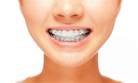 Exploring the Pros and Cons of Different Types of Orthodontic Braces