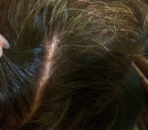Exploring the Symbolic Significance of a Skin Flaking from the Scalp
