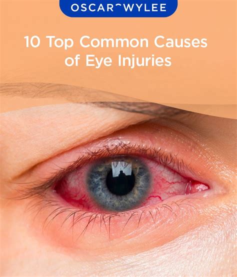 Eye Trauma: The Impact of Injuries on Eye Swelling and Discomfort