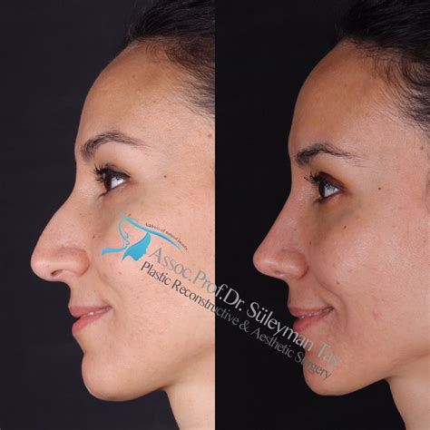 Finding the Perfect Plastic Surgeon for Your Rhinoplasty