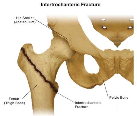 Fractured Hip Dreams: A Symbol of Independence Slipping Away