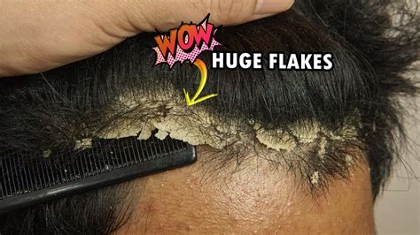 Hair Dandruff - An Unpleasant Visitor on Your Scalp