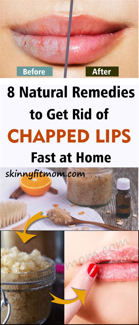 Healing Chapped Lips: Effective Home Remedies