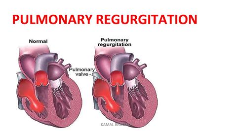 Health Implications in Nighttime Regurgitation Scenarios