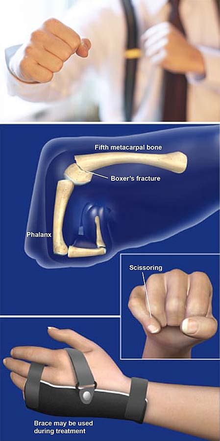 Keeping Injuries at Bay: Precautionary Methods for Boxers