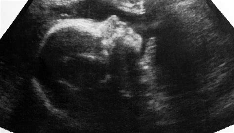 Love at First Sight: Developing a Bond with the Little One on the Ultrasound Screen