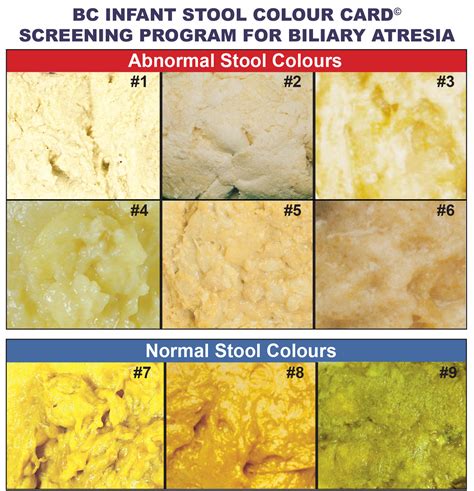 Medical Conditions and Diseases Associated with the Appearance of Yellow Stool