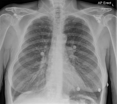 Physical Factors that Could Trigger an Unusual Dream About a Formation in the Chest Region