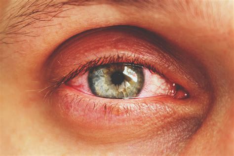 Pink Eye: A Common Eye Infection