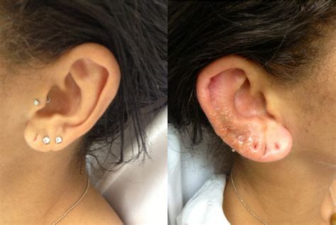 Potential risks and complications of ear piercings