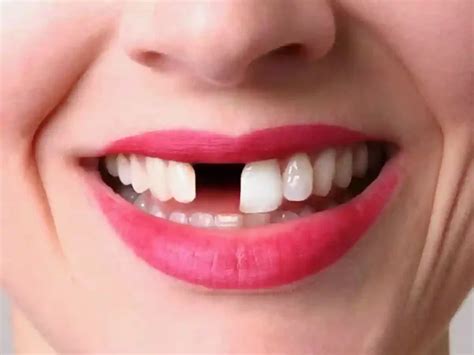 Recognizing the Different Ways Teeth Falling Out Dreams Can Manifest