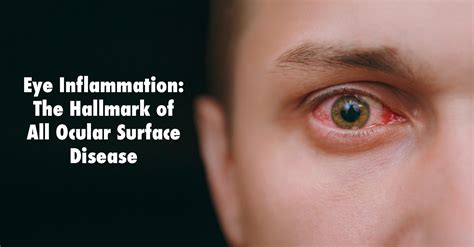 Recognizing the Symptoms: How to Identify an Ocular Inflammation