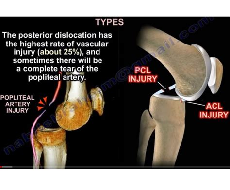 Recognizing the Symptoms of Knee Dislocation