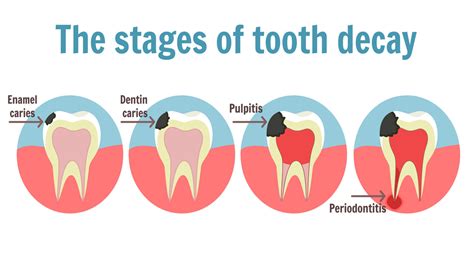 Recognizing the Typical Signs of a Decayed Tooth