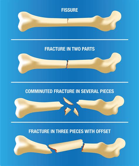 Representation of Limitations and Challenges through a Fractured Limb