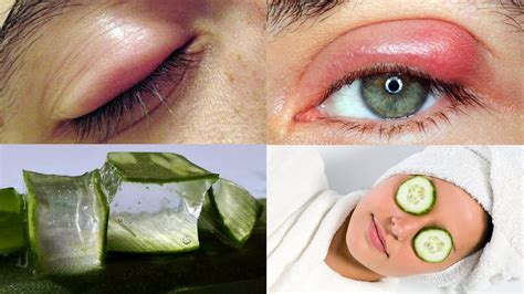 Seeking Relief: Over-the-counter Remedies for Puffy Eyes