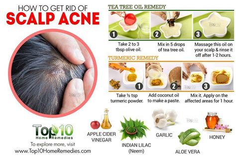 Shooing Pimples Away: Effective Home Remedies to Treat Pimples on the Scalp