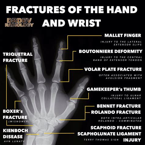 Significance of a fractured left hand in dreams