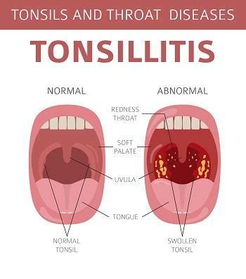 Sudden Discomfort: Identifying Signs of Tonsil Infection