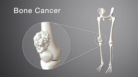 Symbolic Representation of Cancer in the Leg